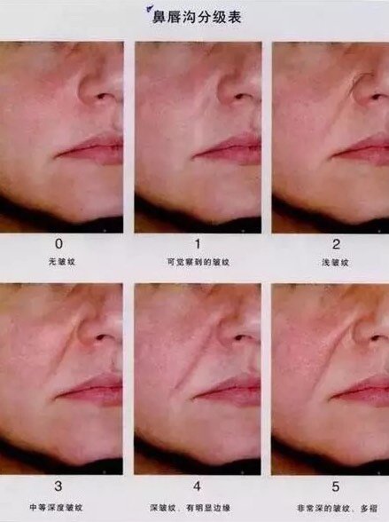 法令纹填充脂肪 吸收率高吗 新氧美容整形