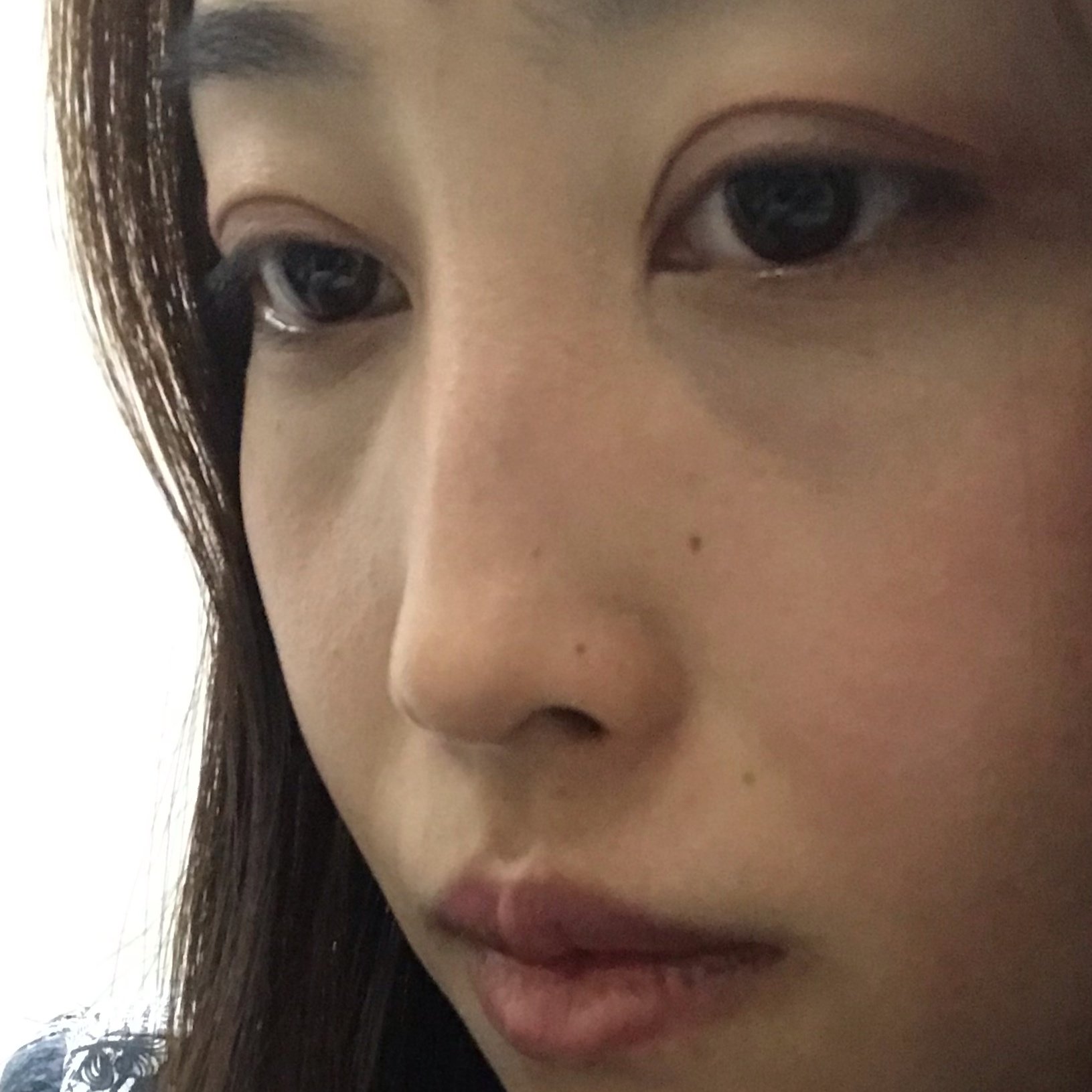 天生低鼻塌鼻梁鼻子上皮肤很薄用手捏只有两层皮想问这种情况能做隆鼻