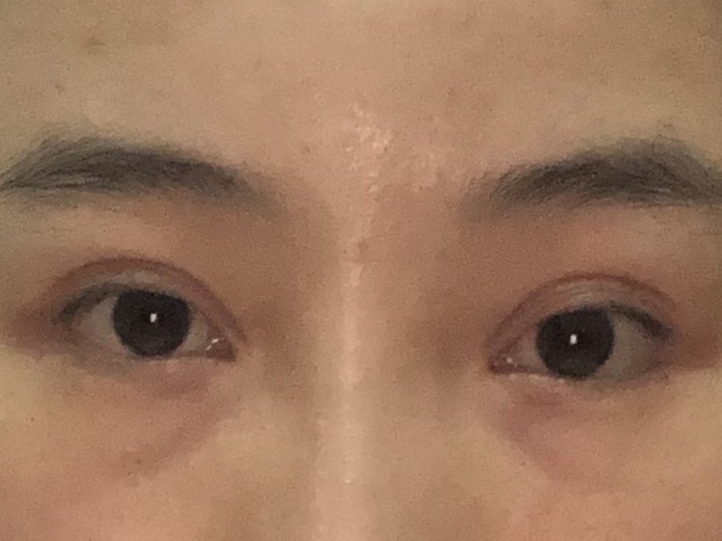 请问我眼睛做过3次了还可以修复吗 眼睛 新氧 专业医美服务平台