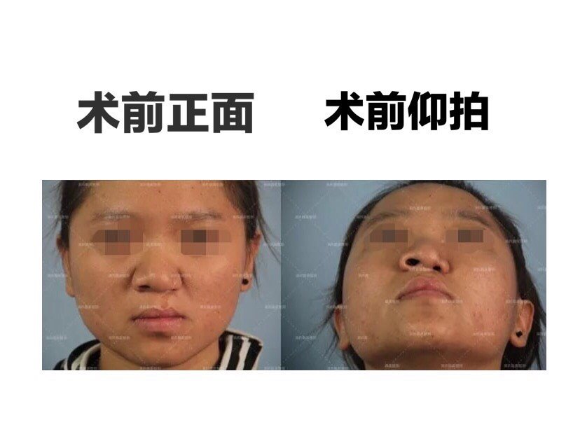 鼻子一边高一边低还有一点歪有什么手 新氧美容整形