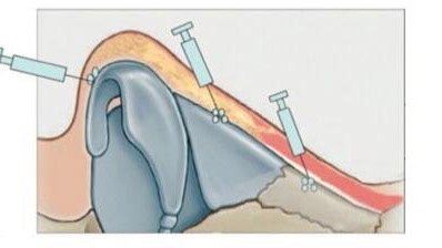 您好,根据您的描述一般玻尿酸隆鼻能维持6~12