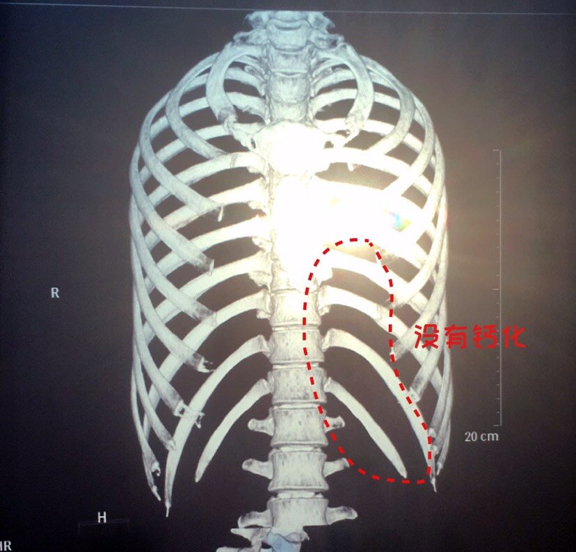 是不是肋软骨钙化就只能做异体骨修复鼻子