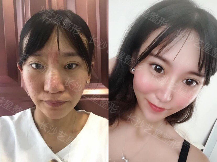 外鼻形成術・鼻中隔矯正術