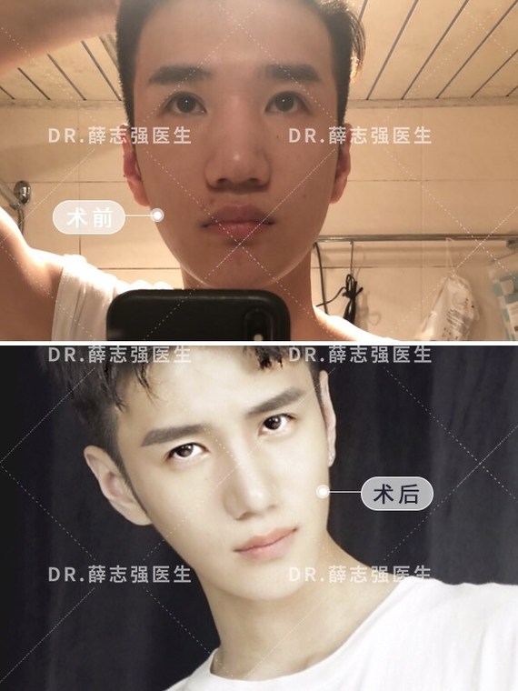 你好。你的主要问题机会鼻小柱太长鼻翼缘退缩