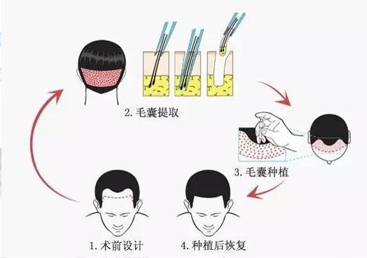 头发移植属于一种微创小手术,过程就是将你自