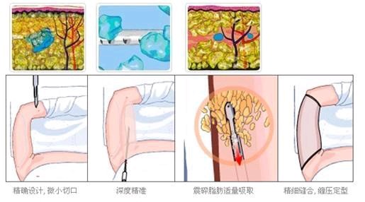 手臂吸脂后会凹凸不平吗 会不会不对称 新氧 专业医美服务平台