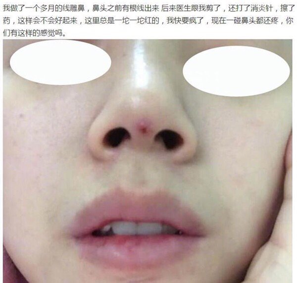 线雕隆鼻可以保持多久 新氧 专业医美服务平台