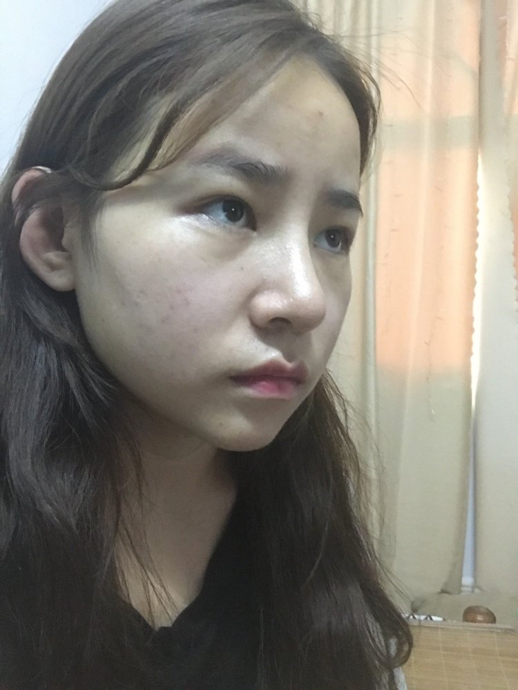 耳软骨隆鼻假体鼻头缩小鼻翼改薄第14天想问下医生我