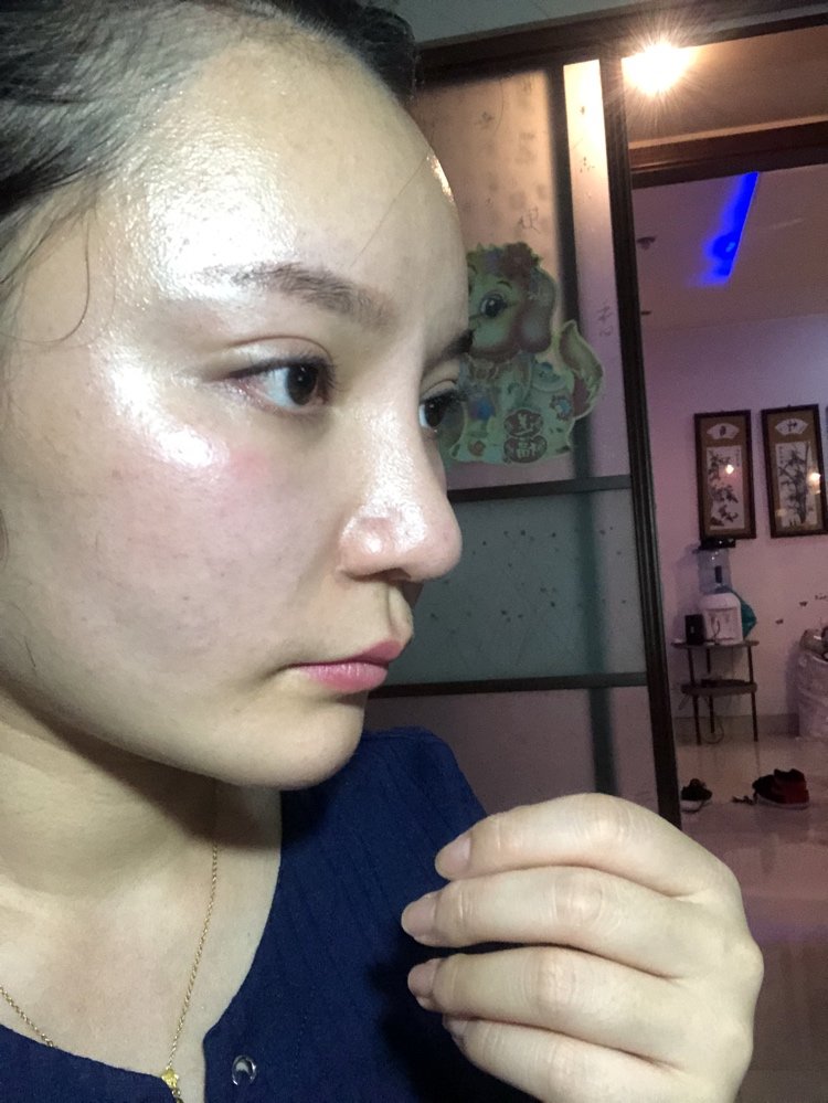 鼻子做过一次单独的鼻头,然后3次鼻部多项_新氧-专业医美服务平台