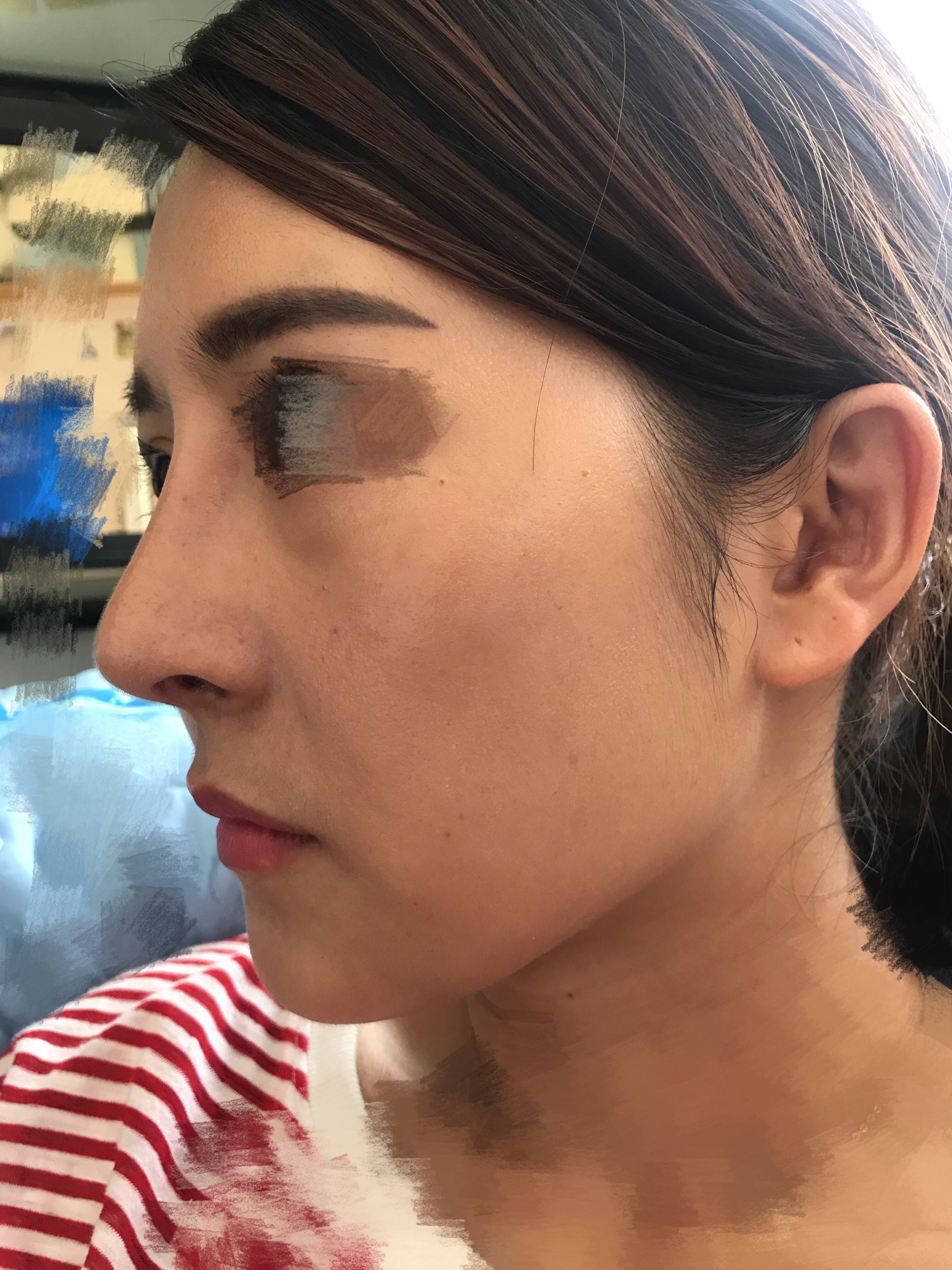 手术后5个半月,马上半年了.山根还是很_新氧美容整形