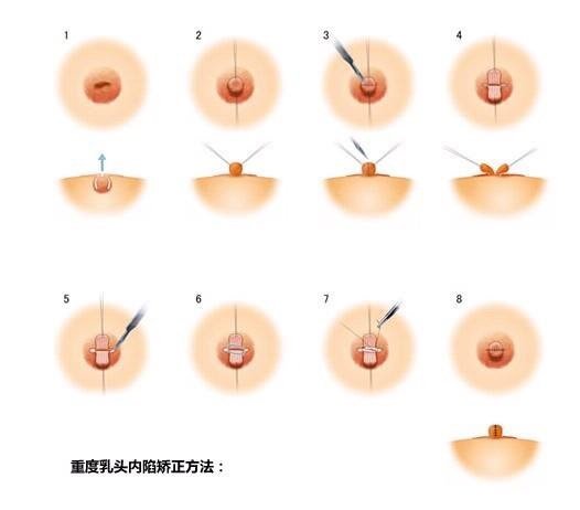 乳头内陷矫正术后怎样护理乳头内陷了去做了矫正手术应该要怎么护理呢