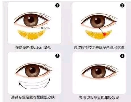 首页 此页面仅支持预览 Avatar 刘彬 18篇日记 您好 去眼袋有两种治疗方法 可分为手术和非手术 祛眼袋整形术是去除眼袋常用的方法 也是眼部美容手术的重要组成部分 内切去眼袋是从眼睛的结膜入路 切口8 12毫米长 将眶内脂肪部分切除即可 方法