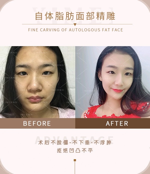 怎么区分卧蚕 眼袋和泪沟 求解答 新氧美容整形