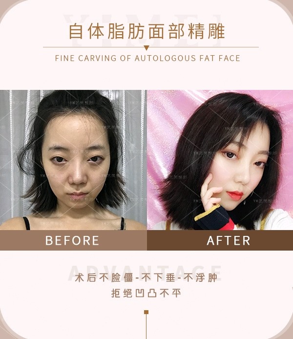 怎么区分卧蚕 眼袋和泪沟 求解答 新氧美容整形