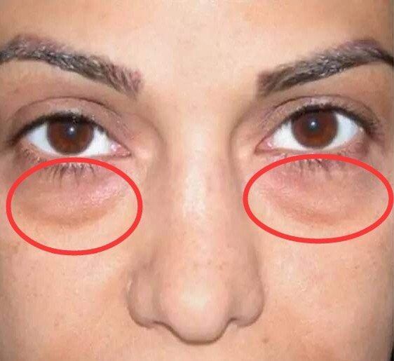 脂肪膨出型:这类眼袋一般是因为眼部缺氧,影响了血液循环和眶部脂肪的