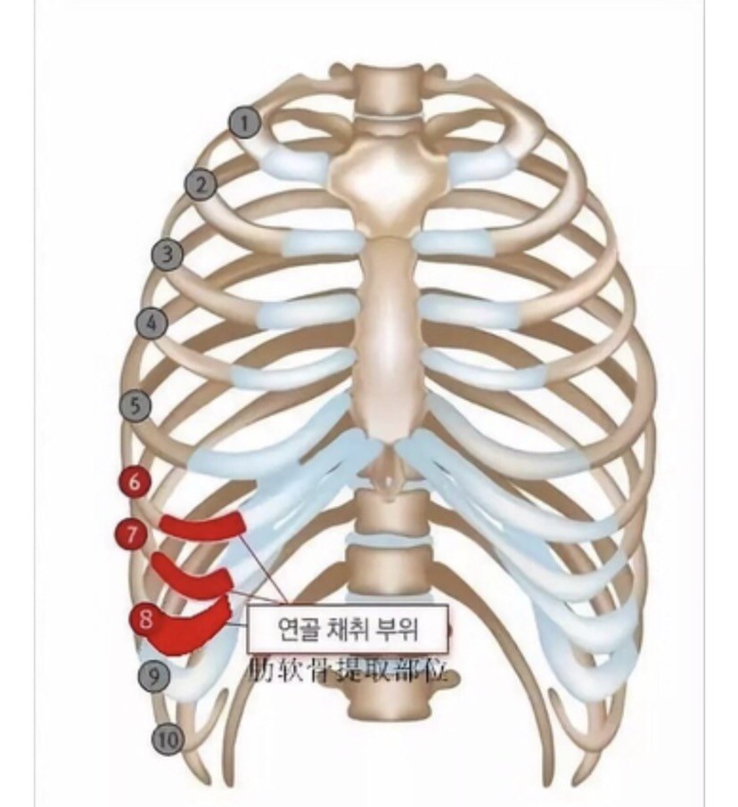 医生 做肋软骨隆鼻 取出来的肋软骨对 新氧美容整形