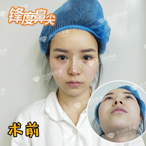 l型假体,可以说是单纯的隆鼻