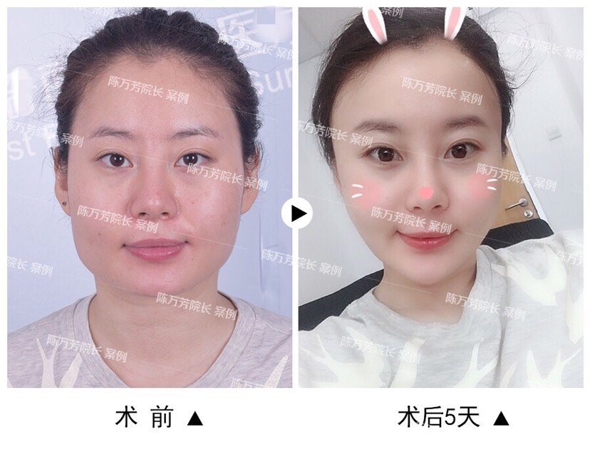 面部脂肪填充过量怎么办 新氧美容整形 面部脂肪填充过量怎么办 新氧美容整形