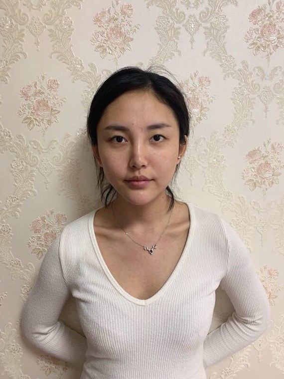 我们都知道割双眼皮的方法一般有以下三种: