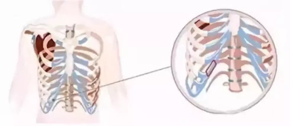 医生 做肋软骨隆鼻 取出来的肋软骨对 新氧美容整形