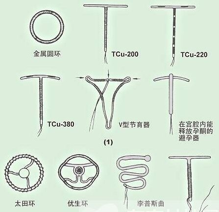 什么是宫内节育器iud