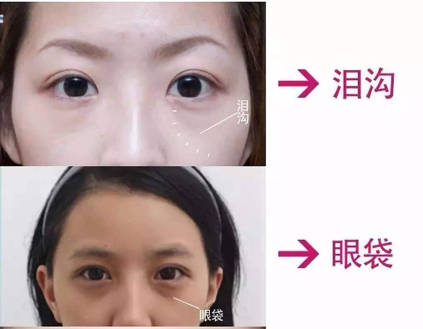 我总是分不清眼袋 卧蚕和泪沟 到底应 新氧美容整形