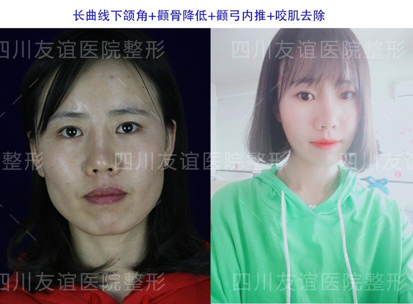 像这种情况需不需要做颧骨内推和下颌骨 新氧美容整形