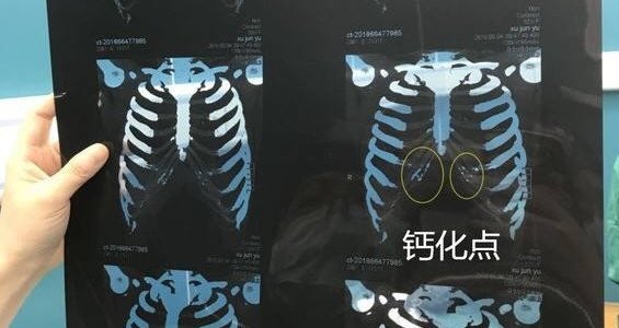 钙化,穿刺判断法容易出错,所以更推荐术前照x光或ct肋骨三维重建诊断