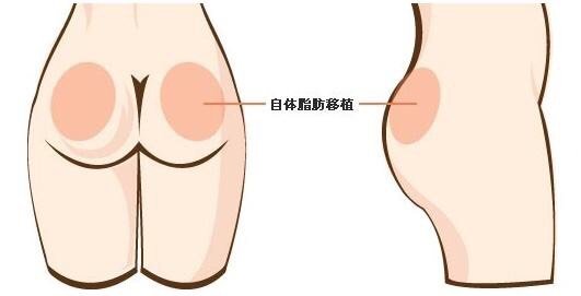 屁股扁平可以用自体脂肪丰臀吗?
