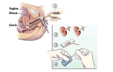妇科检查的tct的用途是什么