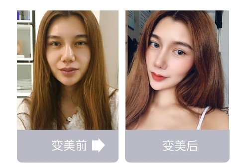 注射隆鼻整形手术费用_鼻子注射整形价格_整形注射隆鼻多少钱