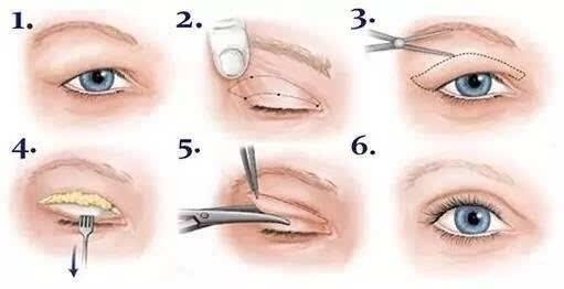 双眼皮分为哪几种 最美观的是哪种 新氧美容整形