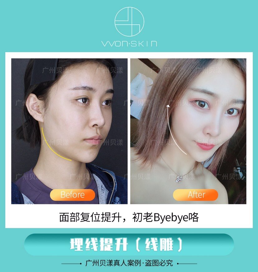 怎么消除法令纹 打玻尿酸填充好还是做 新氧美容整形