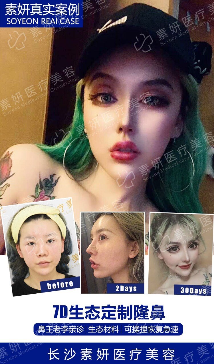 假体隆鼻后还可以捏鼻子吗 新氧美容整形