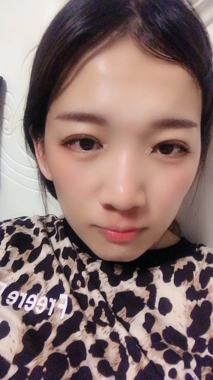 眼睛需要修复了有一侧没做好还有内皮赘肉太厚外眼角一_圈子-新氧美容