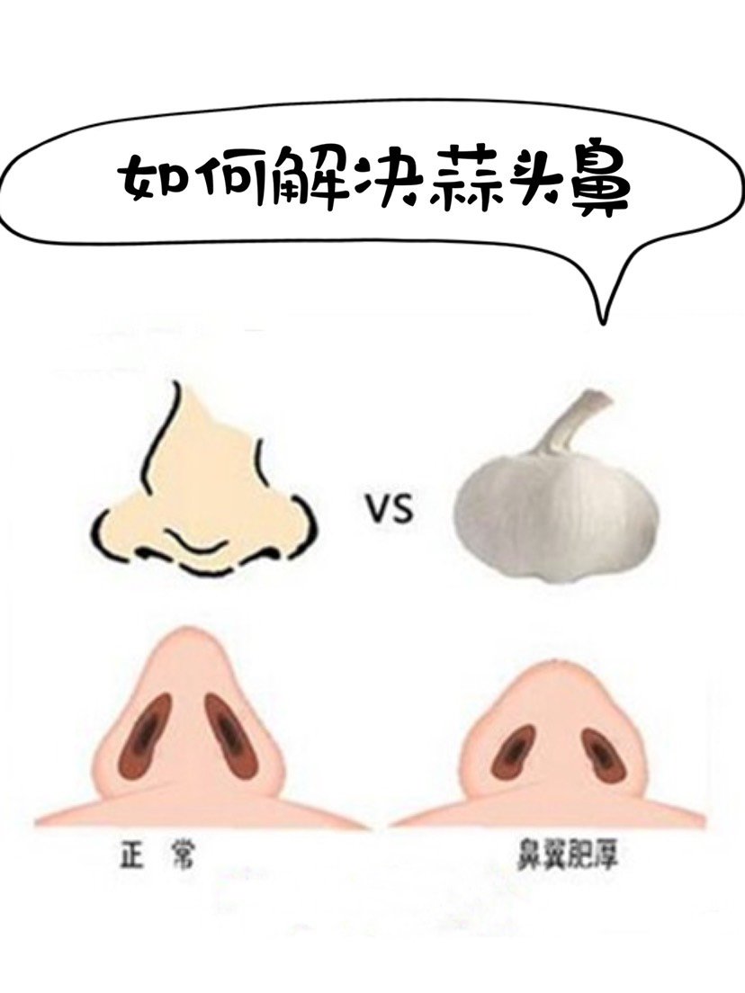 蒜头鼻该怎么解决啊,很烦恼