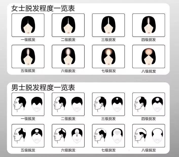这是男女脱发的等级测试表,等级越低的时候植发,效果就会越好