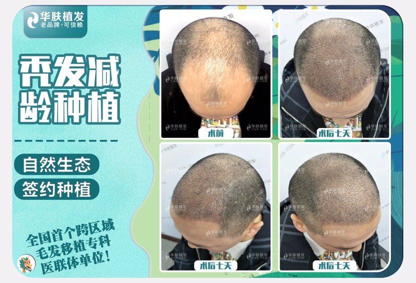 种植头发可以用身体其他部位的发囊种植吗