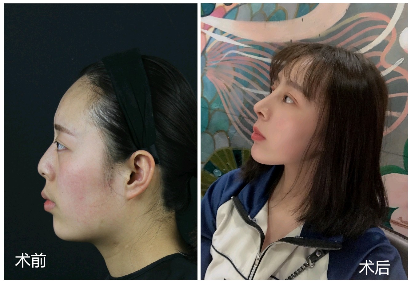 什么是鼻综合?和普通的隆鼻相比有什么不同之处?