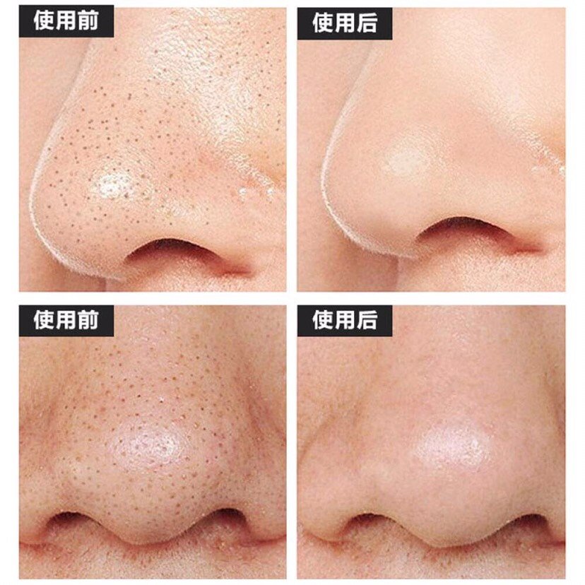 鼻子有黑头怎么办?超微小气泡能能清理鼻子上的黑头吗?