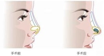 隆鼻为什么要做鼻尖呢 新氧美容整形