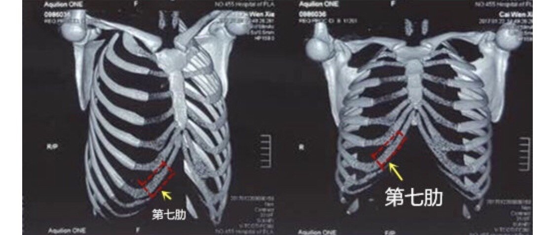 医生说钙化的肋软骨不能用来隆鼻 想知 新氧美容整形