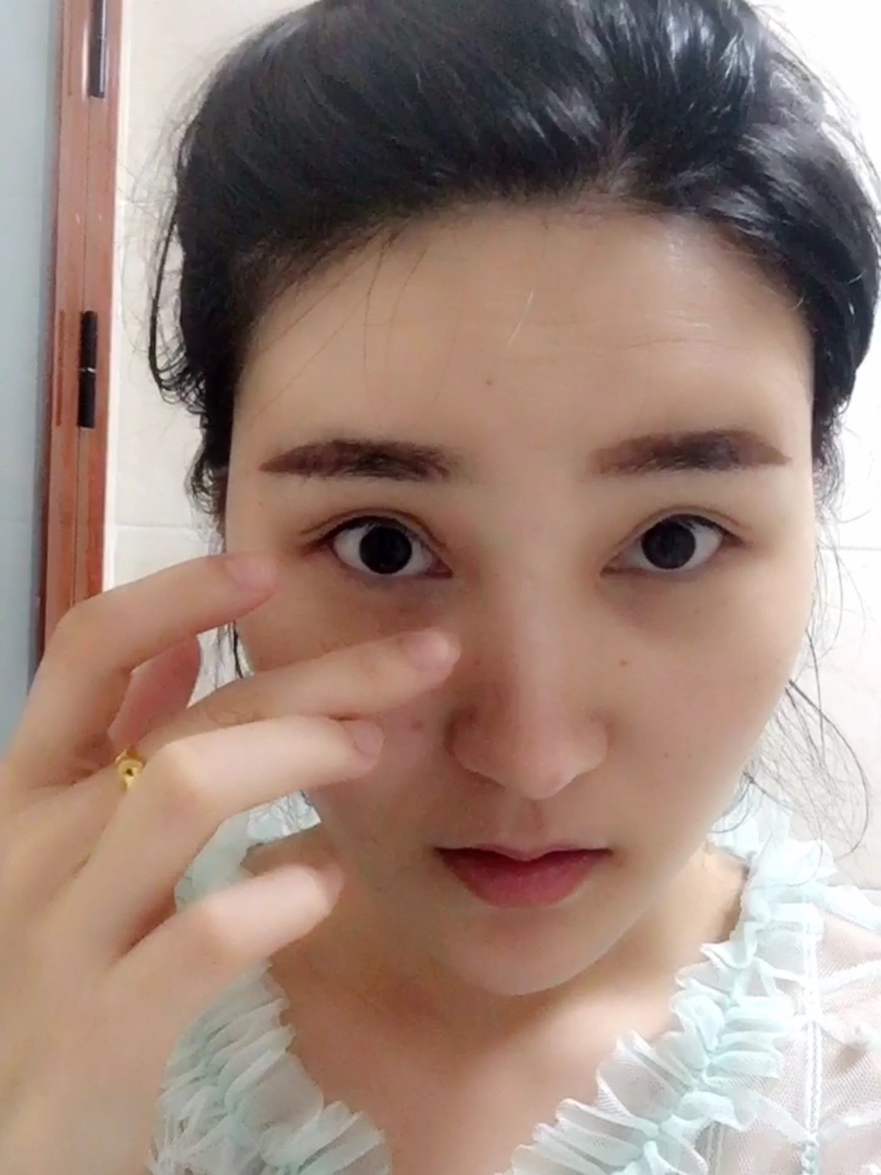 眼珠凹陷上眼眶骨和侧面眼骨凸出由于骨头的限制双眼皮做不宽该怎么办