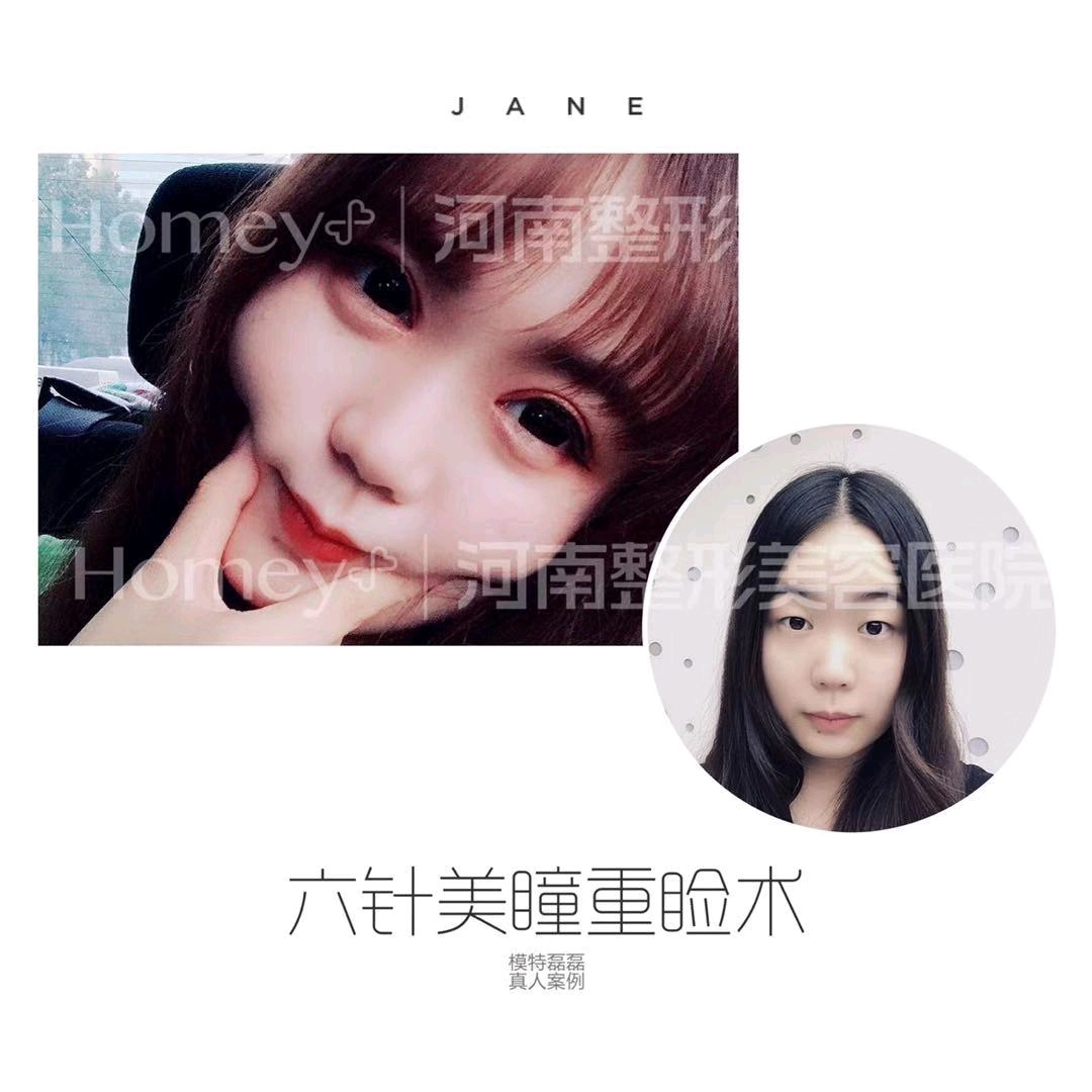 什么样的眼睛不适合开眼角 新氧美容整形