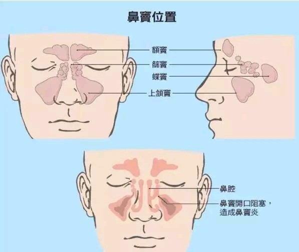 有过敏性鼻炎能不能两隆鼻 新氧美容整形