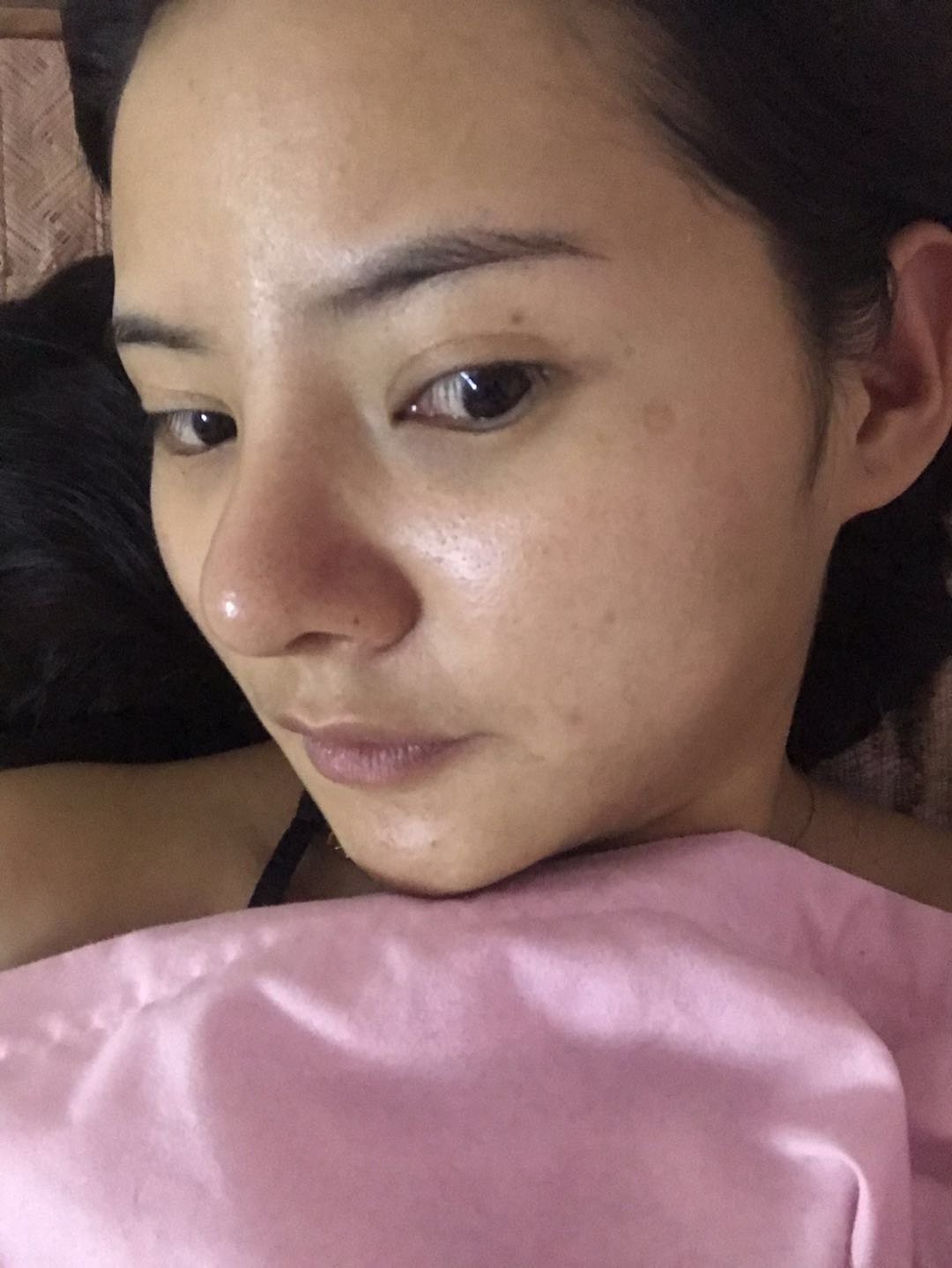 鼻部多项鼻修复两个月鼻梁宽山根太高鼻头又大又圆做了耳软骨鼻尖成型