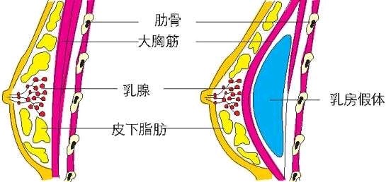 自體脂肪豐胸和假體豐胸有什麼區別