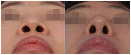 鼻翼缩小是做内切好还是外切好?会不会增生呢?