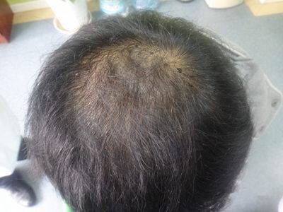 整体头发稀疏可以做植发吗
