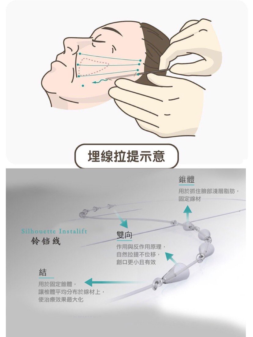 大v线进针点图片